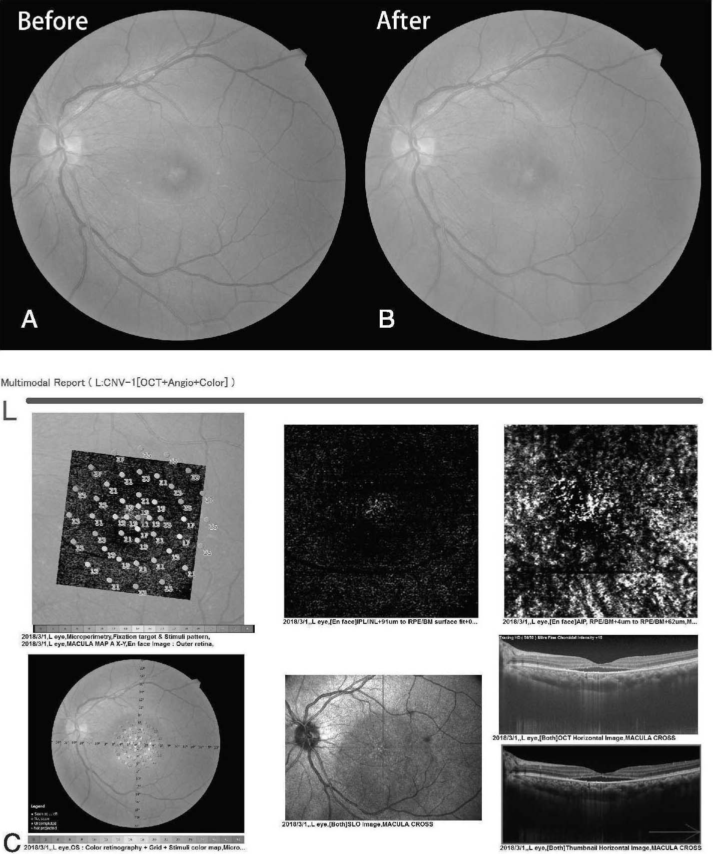 病例2-1-5 诊断:左眼慢性CSC。
